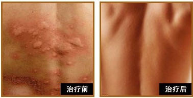 荨麻疹的病因有哪些?如何预防