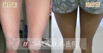 重庆皮肤病医院治疗鱼鳞病的案例,鱼鳞病的症状,鱼鳞病的病因,治疗鱼鳞病的效果